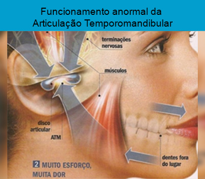 O que e uma disfunção da articulação temporomandibular (ATM)?