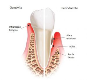 Periodontista em Santos | São Vicente | Guarujá | Praia Grande | Canaan