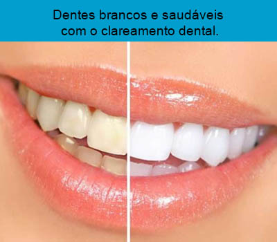 Clareamento Dental em Santos | São Vicente | Guarujá | Praia Grande | Odontologia Canaan 