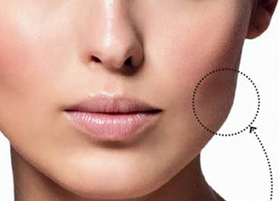 Bichectomia em Santos | São Vicente | Guarujá | Praia Grande | Odontologia Canaan