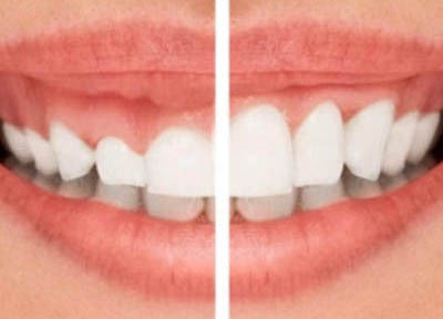 Cirurgia Plástica Gengival em Santos | São Vicente | Guarujá | Praia Grande | Odontologia Canaan