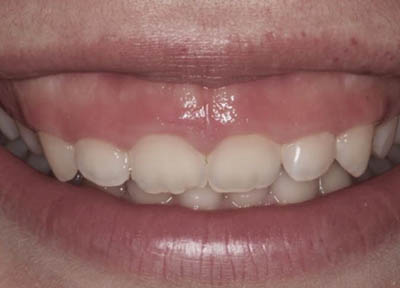 Cirurgia Plástica Gengival em Santos | São Vicente | Guarujá | Praia Grande | Odontologia Canaan