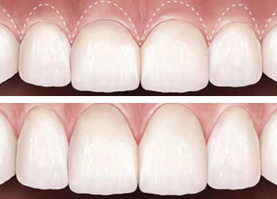 Cirurgia Plástica Gengival em Santos | São Vicente | Guarujá | Praia Grande | Odontologia Canaan
