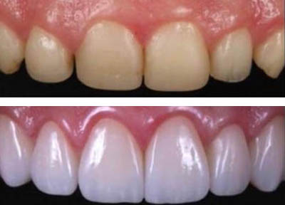 Cirurgia Plástica Gengival em Santos | São Vicente | Guarujá | Praia Grande | Odontologia Canaan