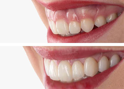 Cirurgia Plástica Gengival em Santos | São Vicente | Guarujá | Praia Grande | Odontologia Canaan