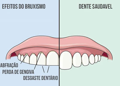 Disfuncao Temporomandibular em Santos 2 Disfunção Temporomandibular em Santos | São Vicente | Guarujá | Praia Grande | Odontologia Canaan