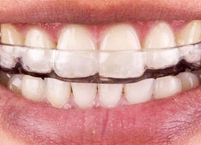 Disfuncao Temporomandibular em Santos 3 Disfunção Temporomandibular em Santos | São Vicente | Guarujá | Praia Grande | Odontologia Canaan