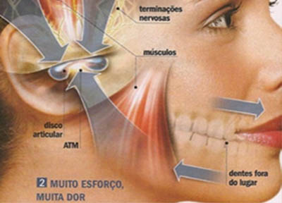 Disfuncao Temporomandibular em Santos 4 Disfunção Temporomandibular em Santos | São Vicente | Guarujá | Praia Grande | Odontologia Canaan
