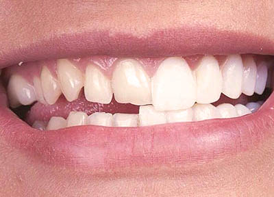 Lentes de Contato Dentais em Santos | São Vicente | Guarujá | Praia Grande | Odontologia Canaan