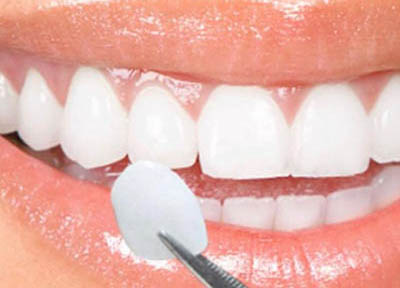 Lentes de Contato Dentais em Santos | São Vicente | Guarujá | Praia Grande | Odontologia Canaan