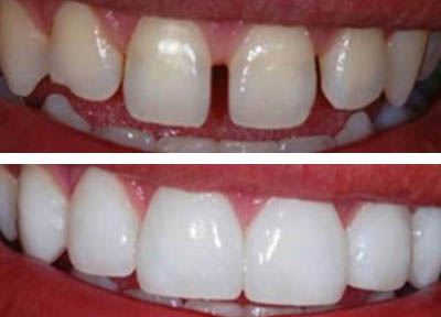 Lentes de Contato Dentais em Santos | São Vicente | Guarujá | Praia Grande | Odontologia Canaan