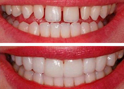 Lentes de Contato Dentais em Santos | São Vicente | Guarujá | Praia Grande | Odontologia Canaan