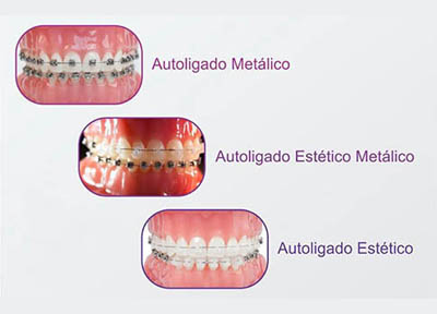 Ortodontista em Santos | São Vicente | Guarujá | Praia Grande | Odontologia Canaan