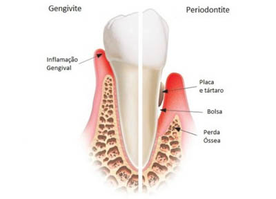 Periodontista em Santos | São Vicente | Guarujá | Praia Grande | Odontologia Canaan