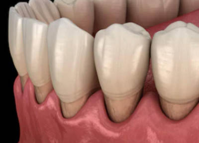 Periodontista em Santos | São Vicente | Guarujá | Praia Grande | Odontologia Canaan