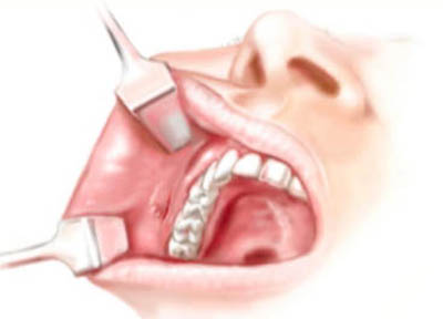 Lipoplastia Facial em Santos | São Vicente | Guarujá | Praia Grande | Odontologia Canaan