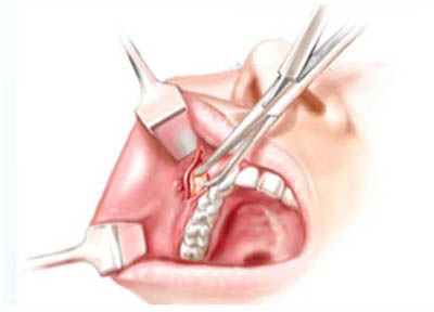 Lipoplastia Facial em Santos | São Vicente | Guarujá | Praia Grande | Odontologia Canaan