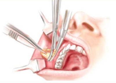 Lipoplastia Facial em Santos | São Vicente | Guarujá | Praia Grande | Odontologia Canaan